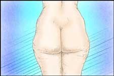la lipoplastica aiuta a eliminare sgradevoli protuberanze togliendo gli eccessi localizzati di grassola lipoplastica aiuta a eliminare sgradevoli protuberanze togliendo gli eccessi localizzati di grasso